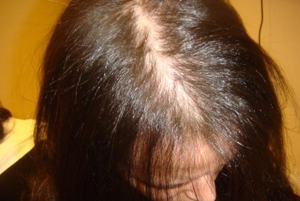 alopeciya